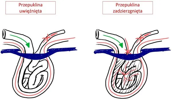 Uwięźnięta przepuklina pachwinowa