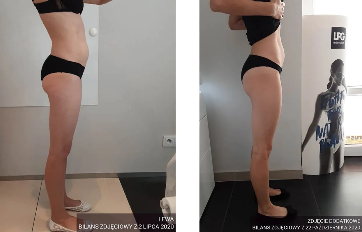 endermologia cellulit przed po