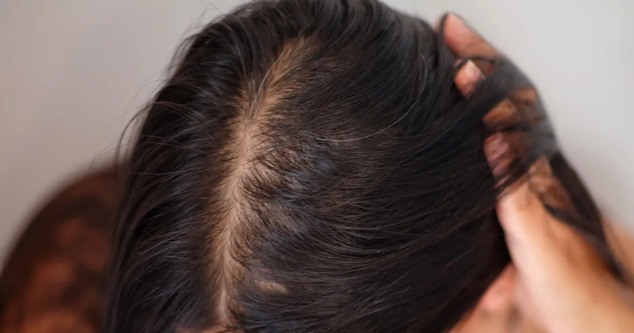 Przyczyny wypadania włosów infografika