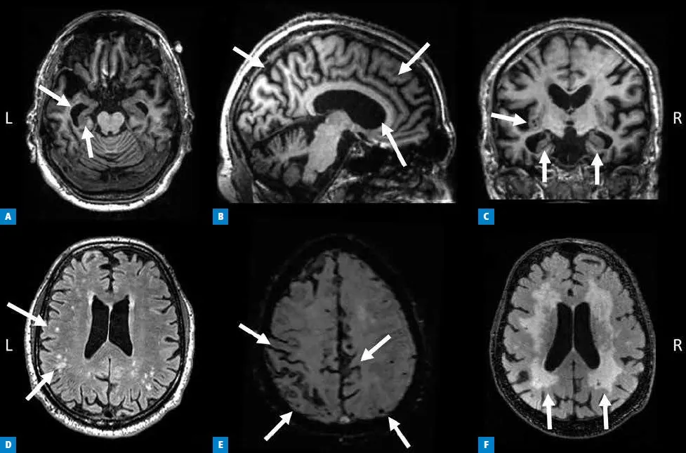 atrofia mózgu choroba Alzheimera MRI