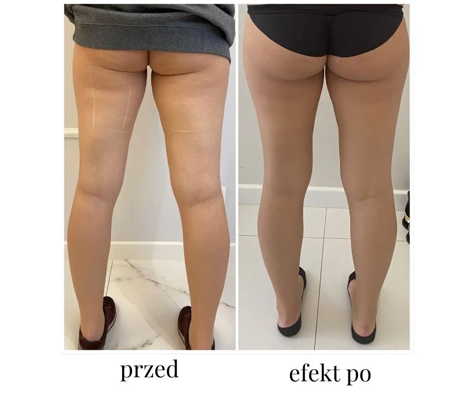 sylwetka biegacza nogi pośladki przed po