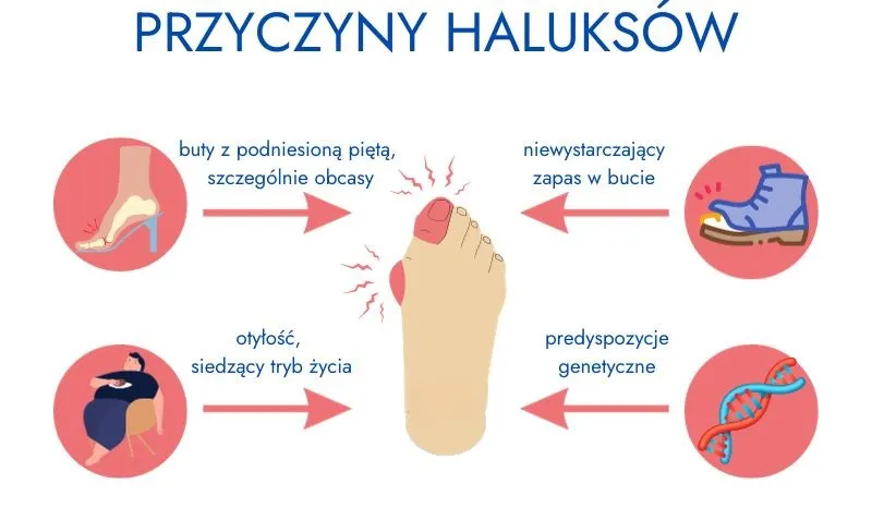 haluksy przyczyny obuwie styl życia