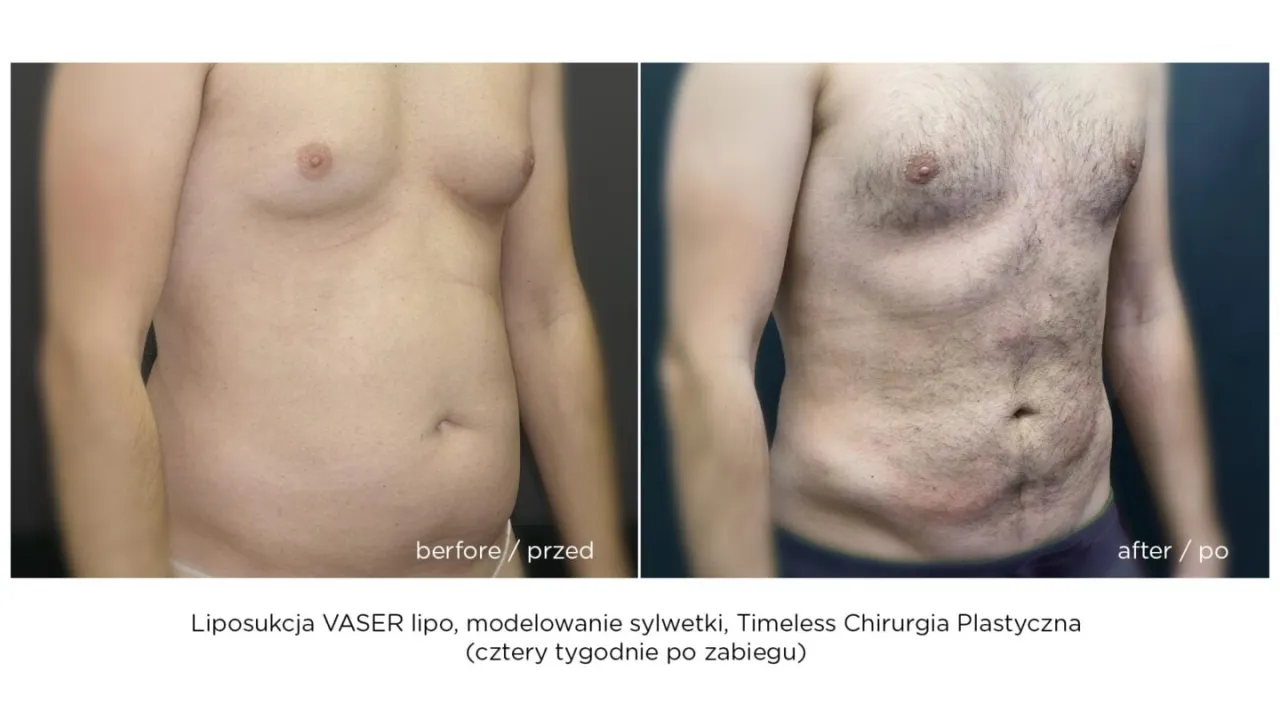 liposukcja przed i po modelowanie sylwetki