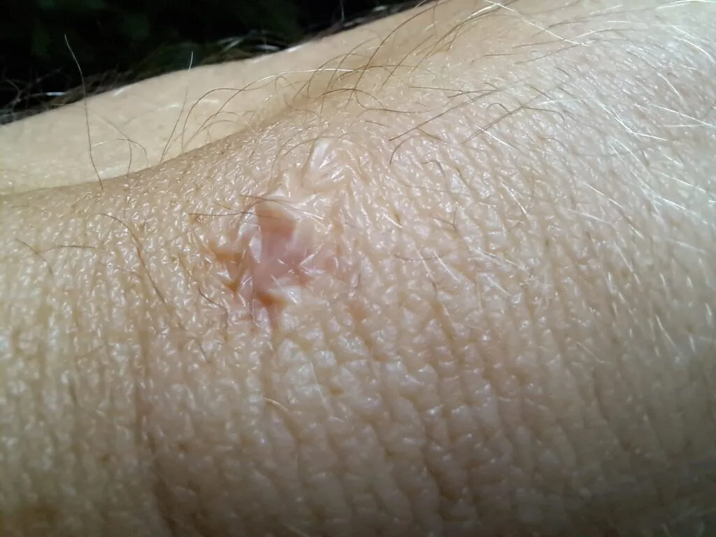 Proces gojenia się rany po szwach grafika