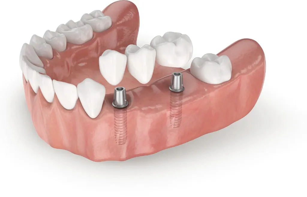 r&oacute;żne metody uzupełniania brak&oacute;w zębowych implant most proteza
