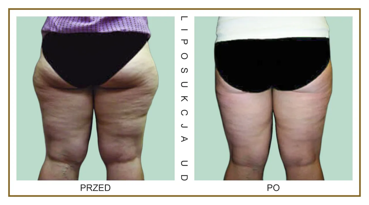 rodzaje liposukcji por&oacute;wnanie