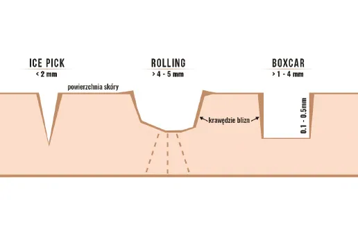 rodzaje blizn potrądzikowych schemat