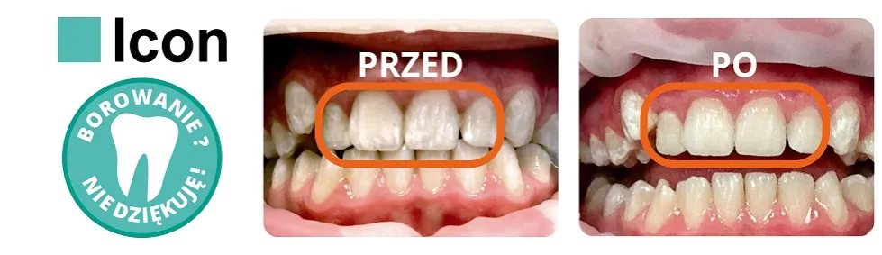 nowoczesne leczenie próchnicy bez borowania ICON ozonoterapia