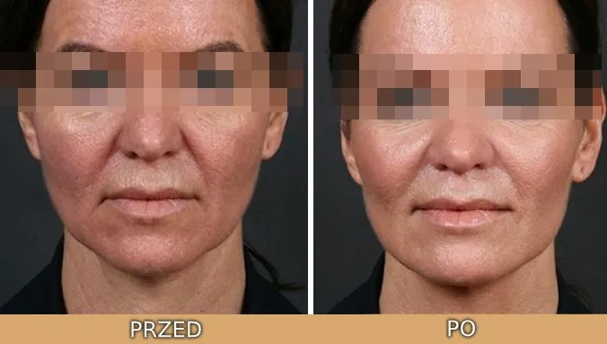 kwas glikolowy przed i po, r&oacute;żne typy cery