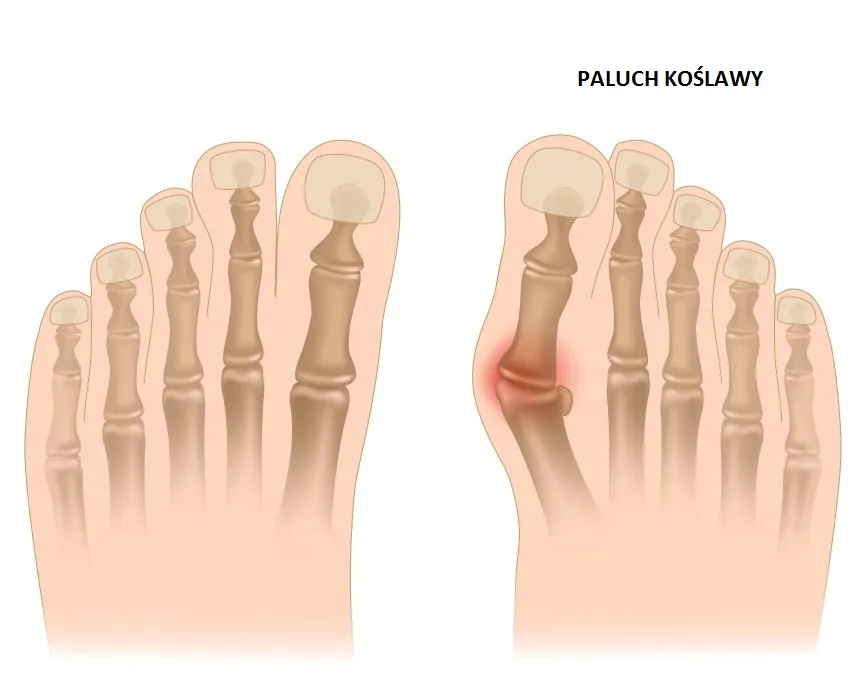 haluksy rtg, operacja haluksa schemat