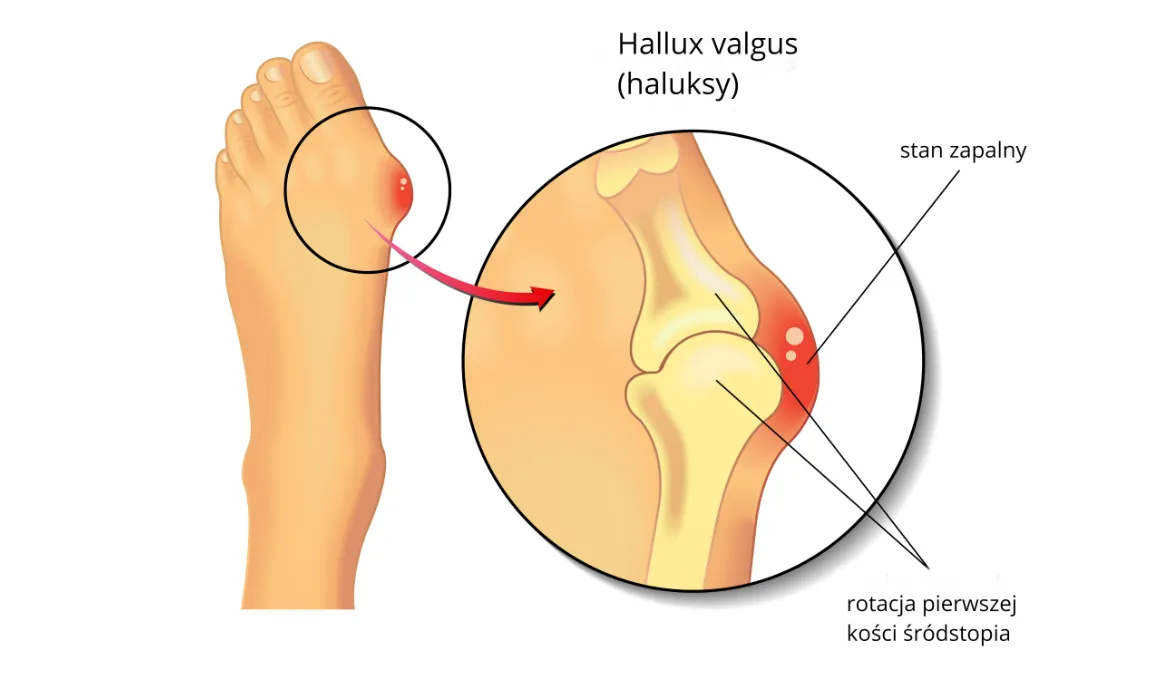Anatomia stopy z haluksem i mechanizm b&oacute;lu