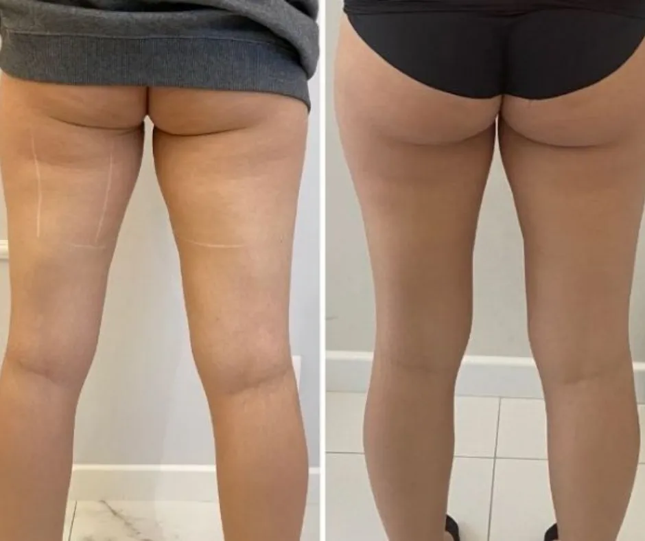 bieganie redukcja cellulitu przed po