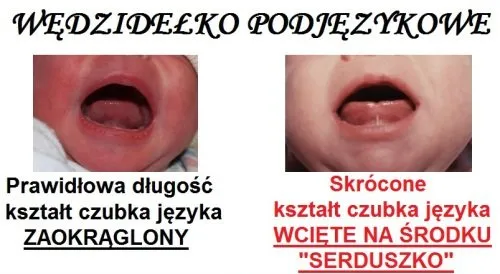 objawy skróconego wędzidełka u niemowlaka karmienie piersią