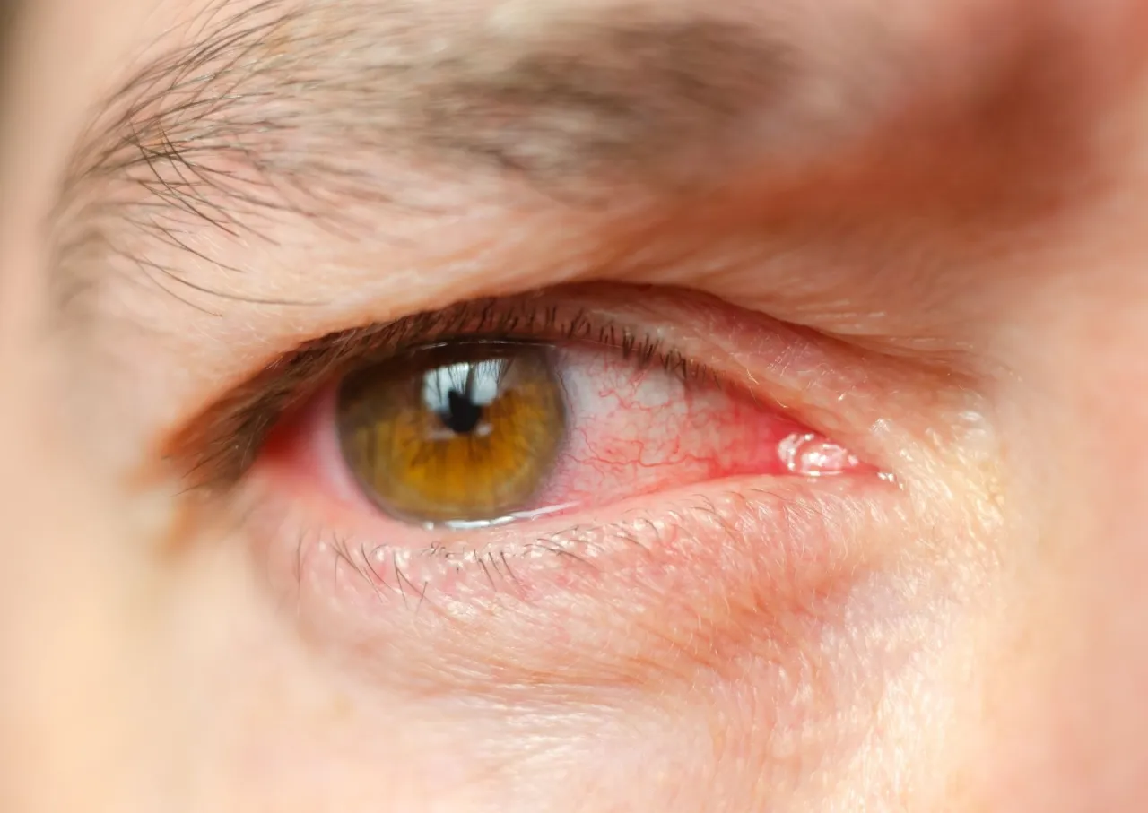 objawy ostrego ataku jaskry, oko zaczerwienione tęczowe koła