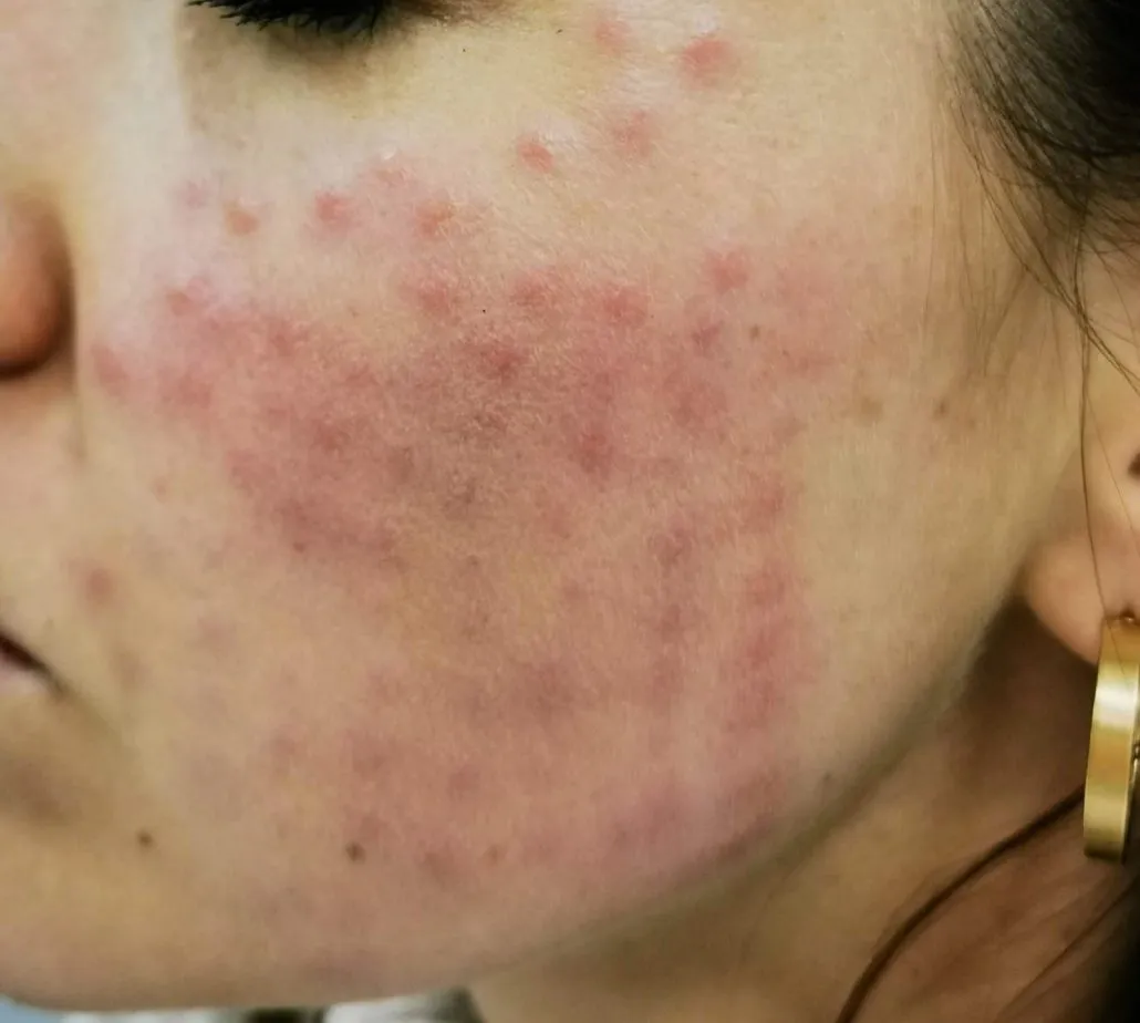 Opuchlizna i siniaki po zabiegu medycyny estetycznej