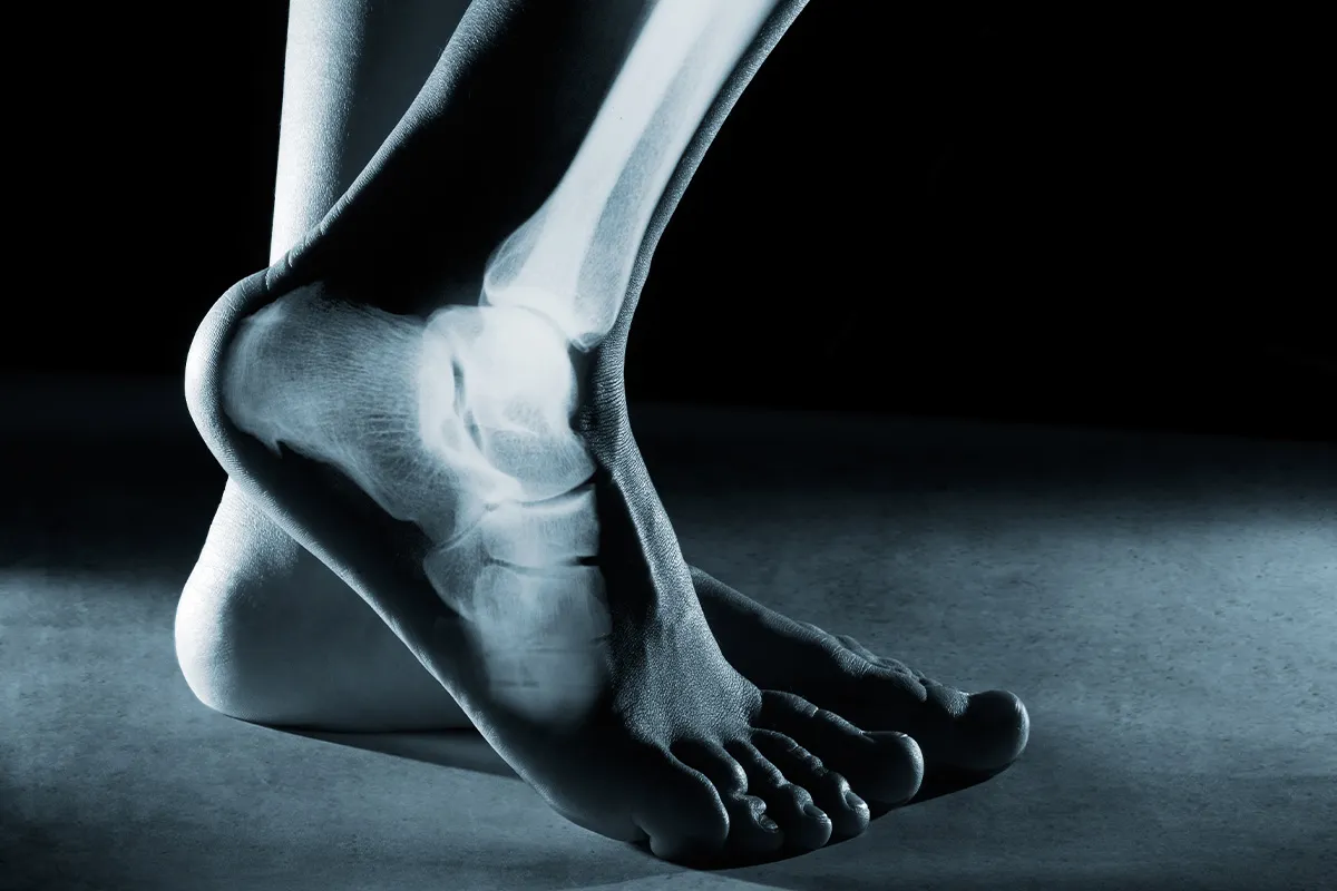 Rentgen stopy z widocznymi kośćmi. Zastanawiasz się, ile trwa rehabilitacja po artroskopii stawu skokowego?