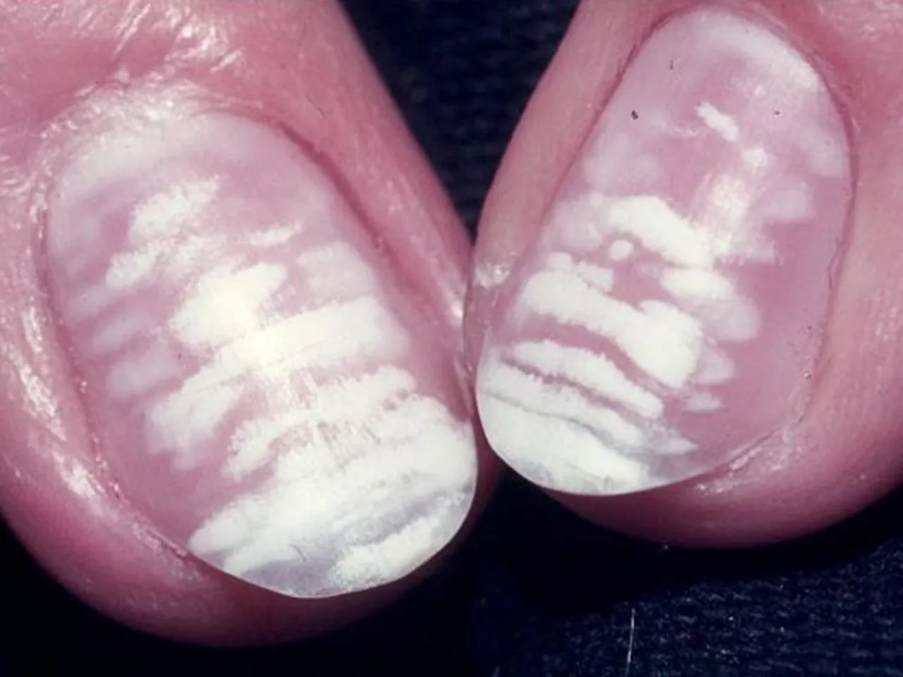 wei&szlig;e flecken nagel mikroverletzung