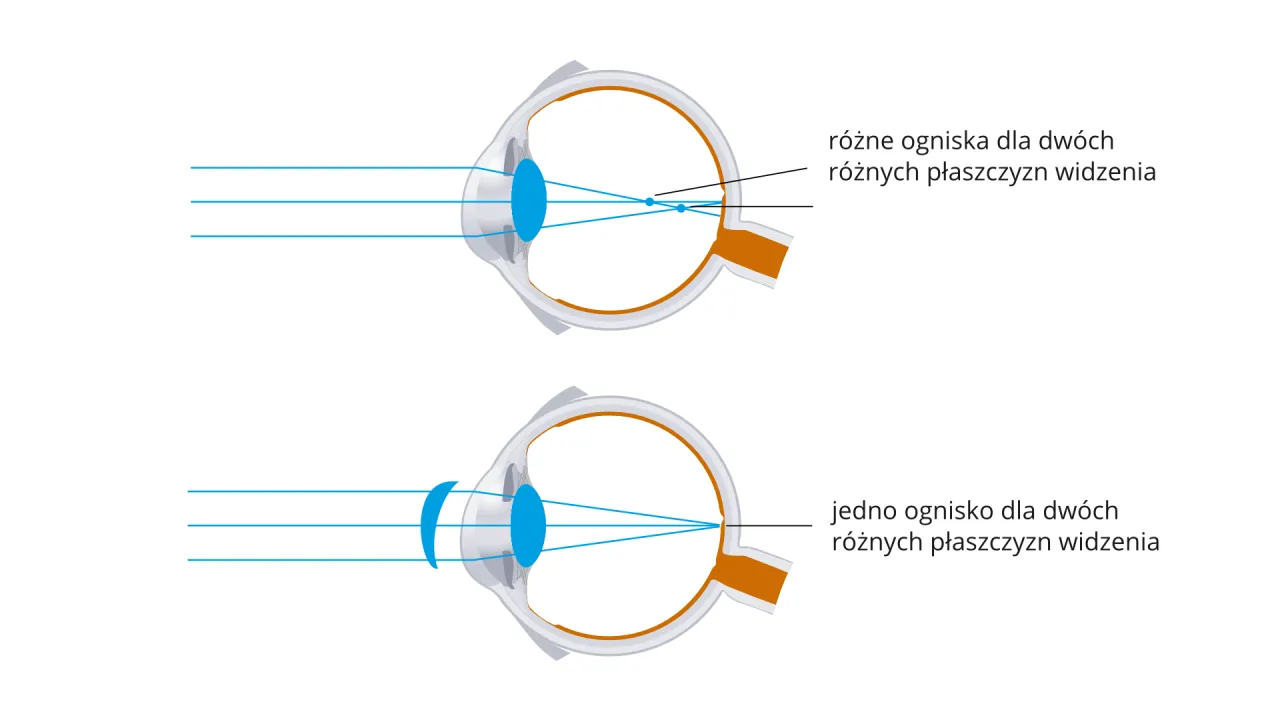 schemat kr&oacute;tkowzroczność dalekowzroczność oko