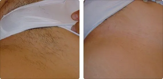 depilacja laserowa bikini efekty przed i po