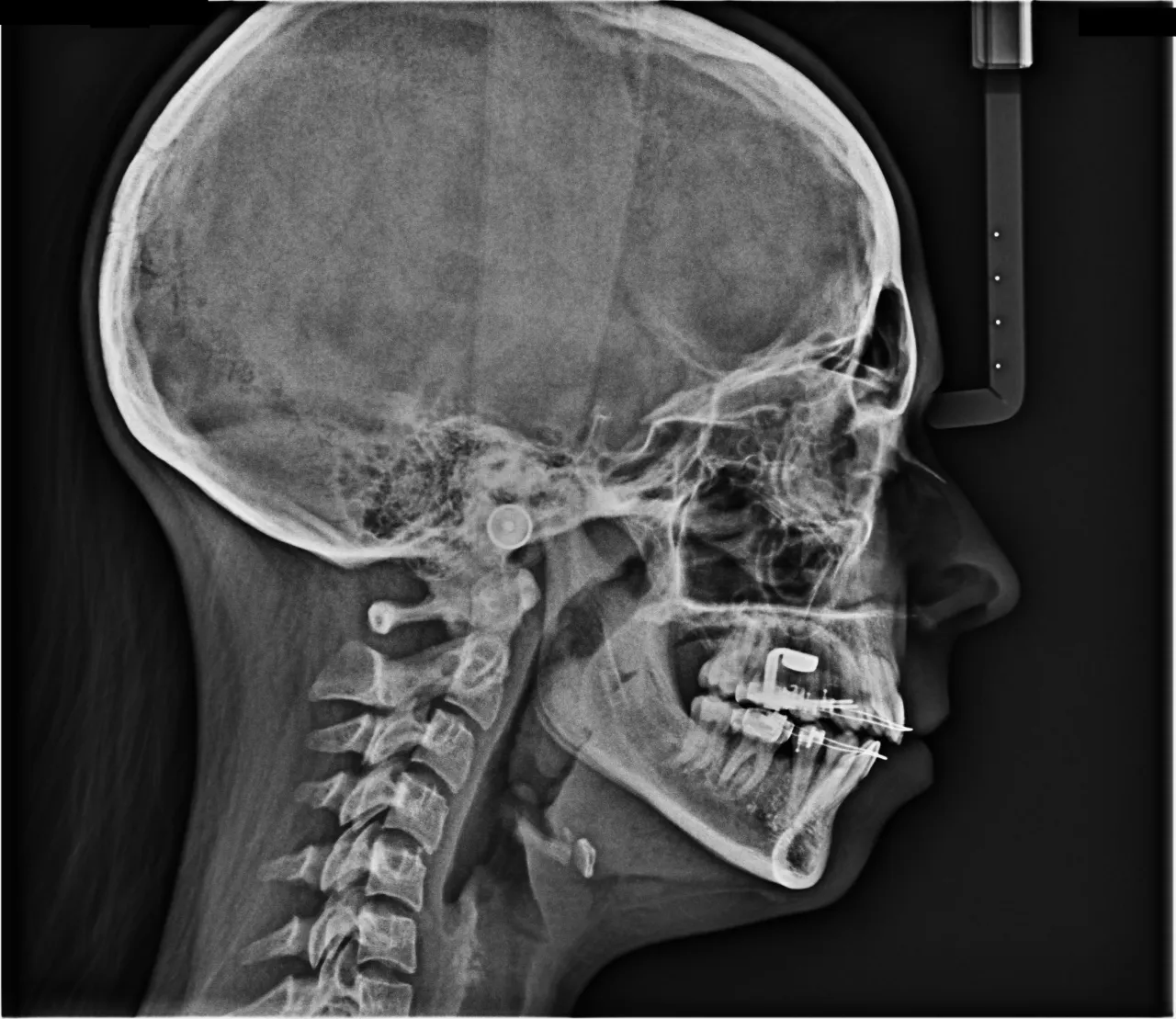 zdjęcia rtg ortodontyczne pantomogram cefalometria