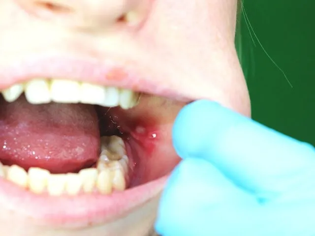 afty w jamie ustnej przyczyny