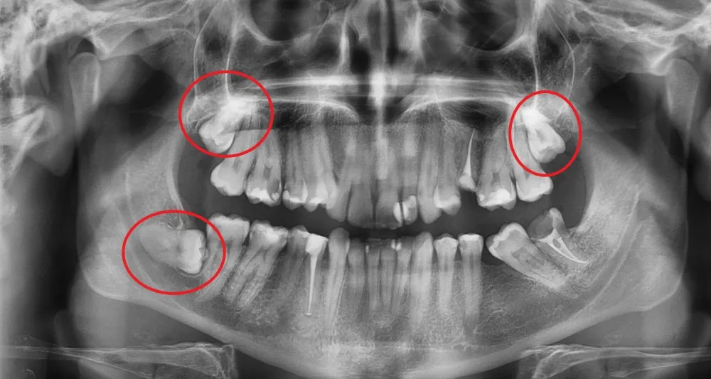 rentgen zatrzymanej ósemki, zdjęcie pantomograficzne zębów mądrości