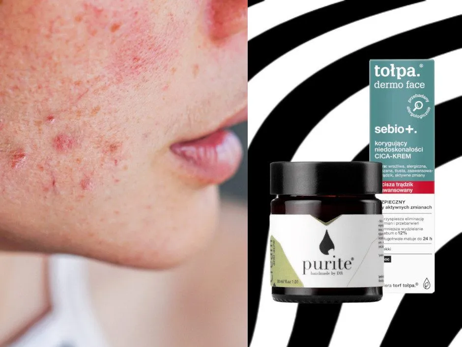 Skuteczne preparaty na trądzik