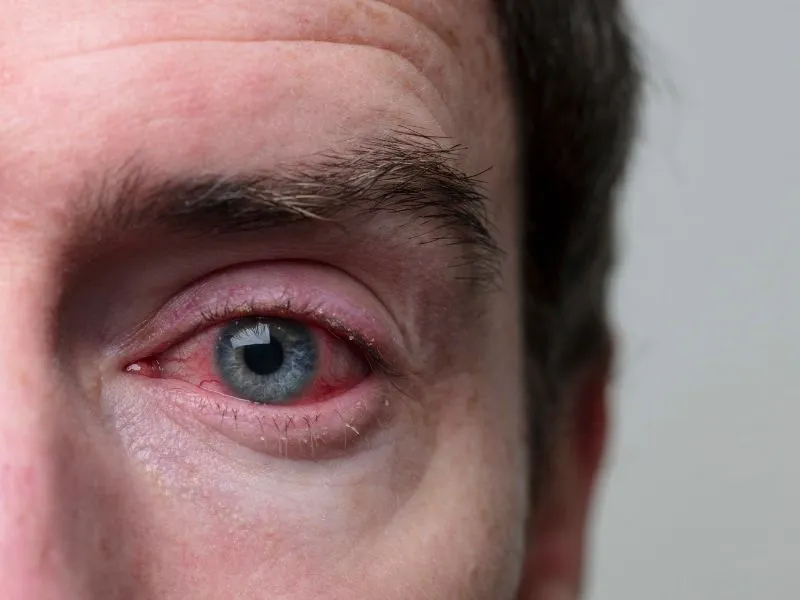 Infekcje oka soczewki kontaktowe