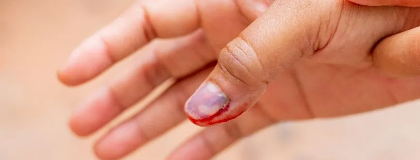 objawy złamania palca vs stłuczenia