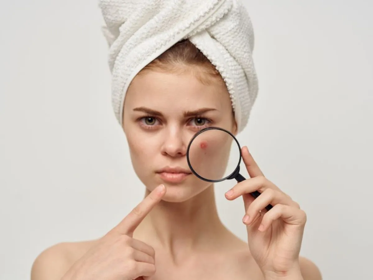 codzienna pielęgnacja cery trądzikowej kroki