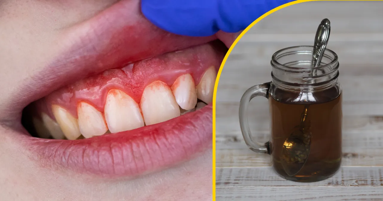 domowe sposoby na opuchnięte dziąsła zioła sól