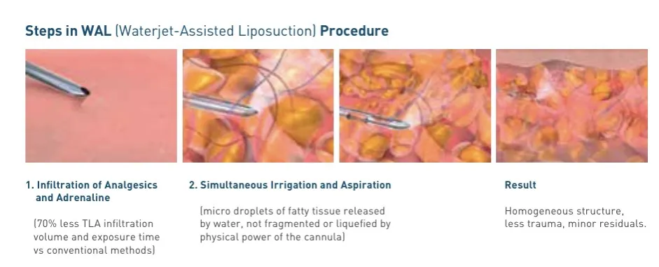 Rodzaje liposukcji schemat