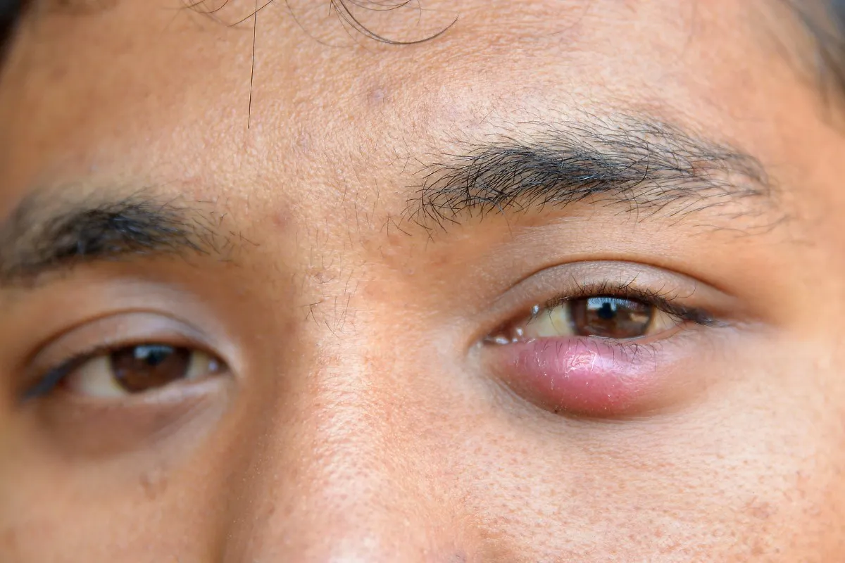 ciepły okład na jęczmień na oku