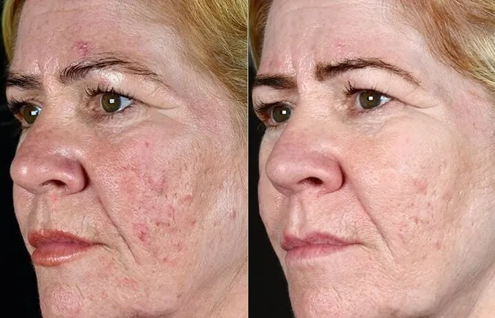 laser frakcyjny blizny po trądziku