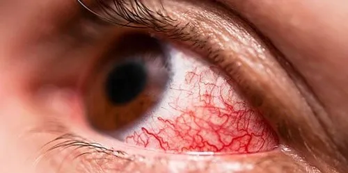Oko z ostrym atakiem jaskry zaczerwienienie