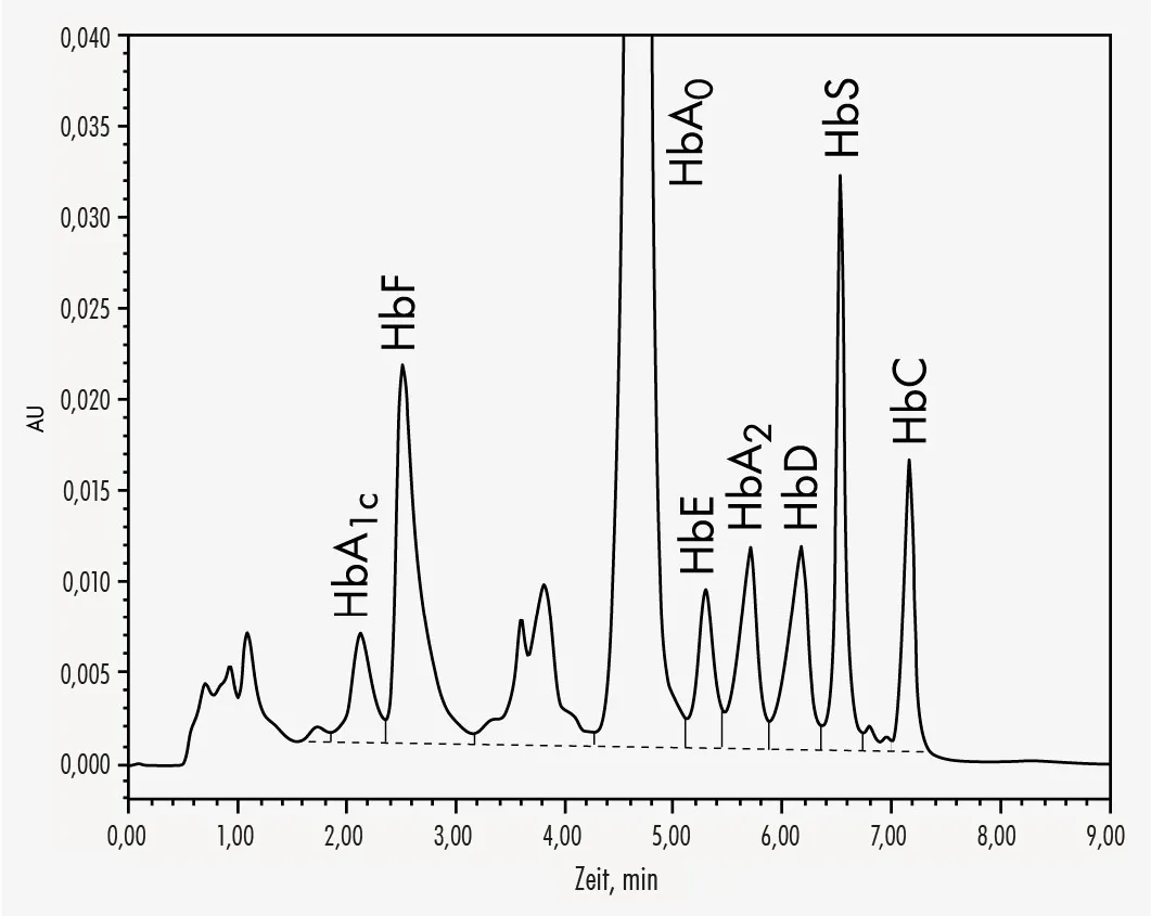 H&auml;moglobin-Elektrophorese HPLC Ergebnis Sichelzellan&auml;mie