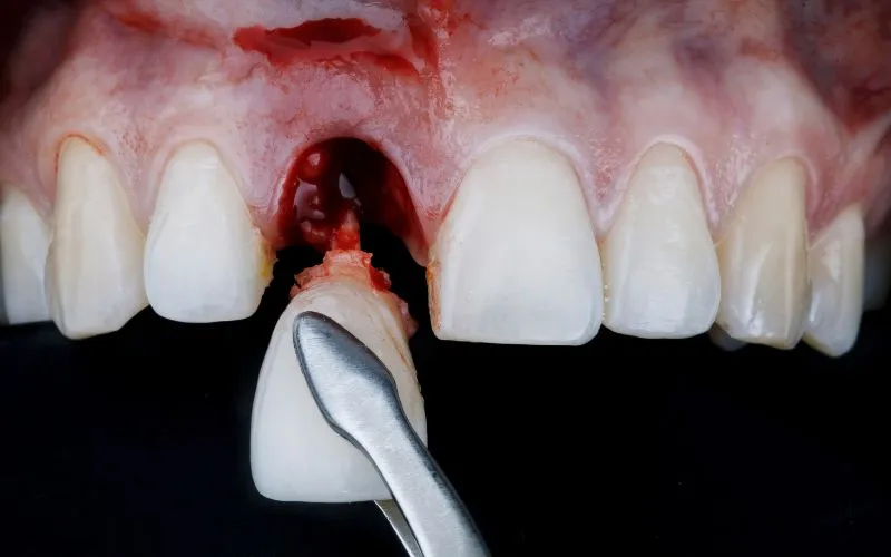 Prawidłowy skrzep po wyrwaniu zęba - wygląd