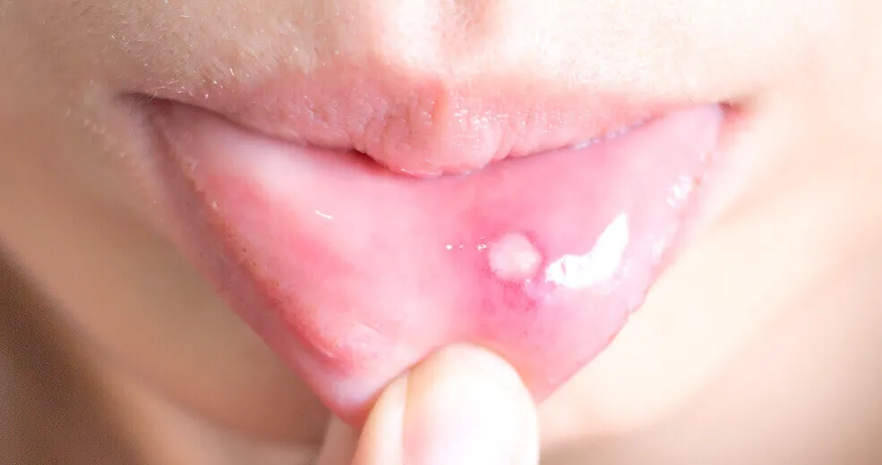 Afty w jamie ustnej - wygląd i lokalizacja