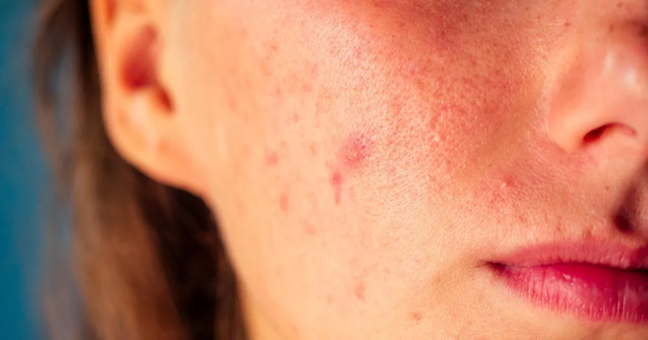 Co zrobić po wyciśniętym pryszczu