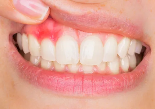 wizyta u dentysty zapalenie dziąseł