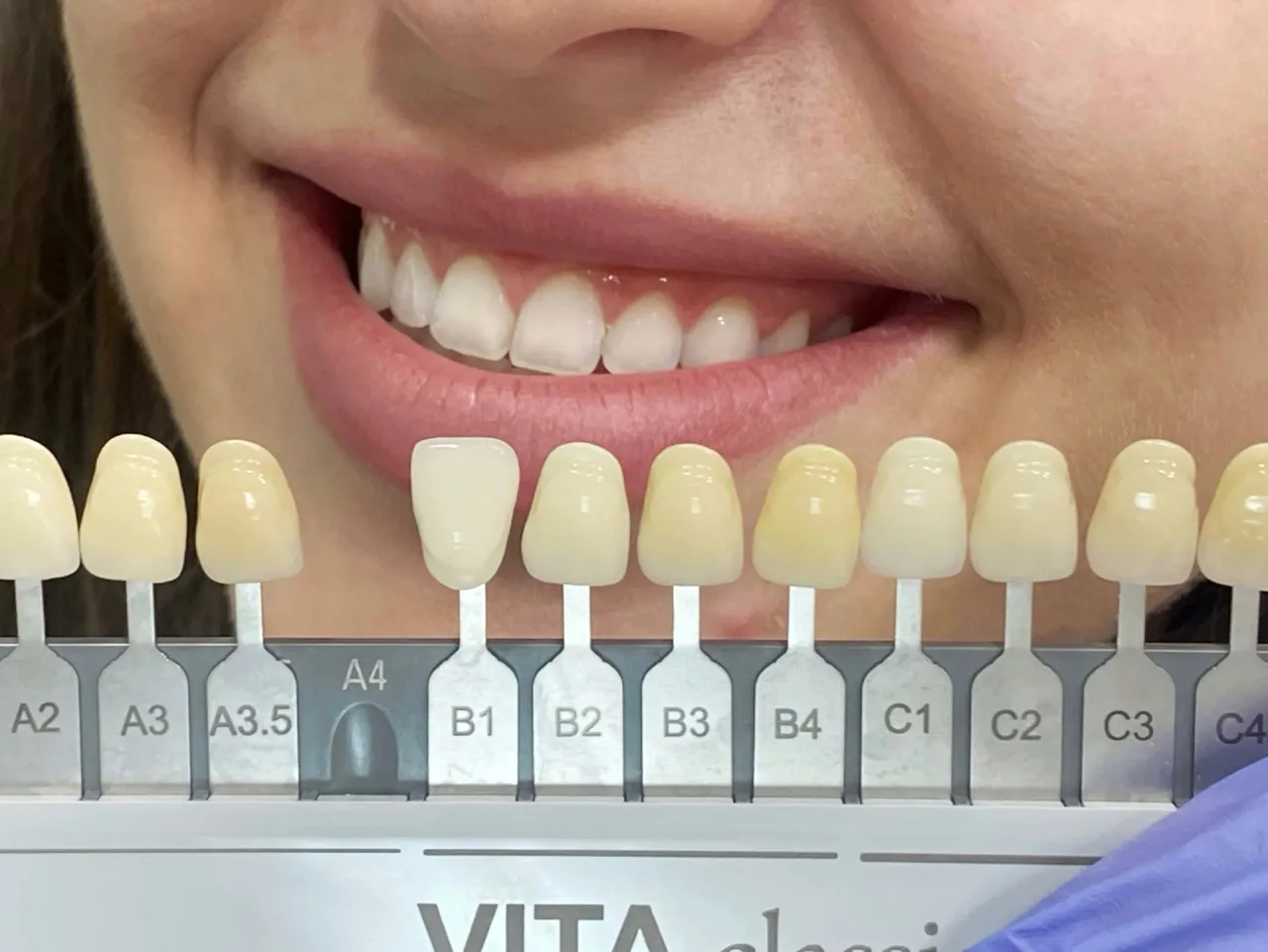 różne metody wybielania zębów u dentysty