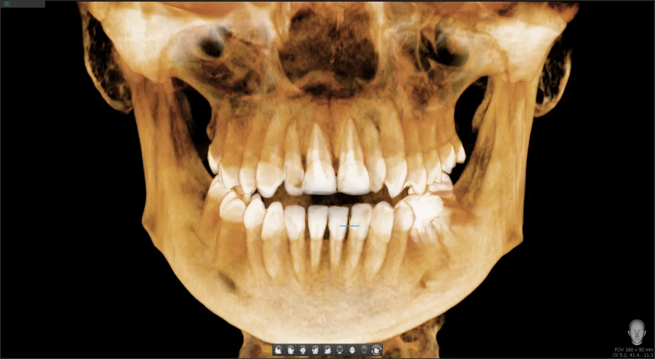 tomografia zęba obraz 3D rekonstrukcja