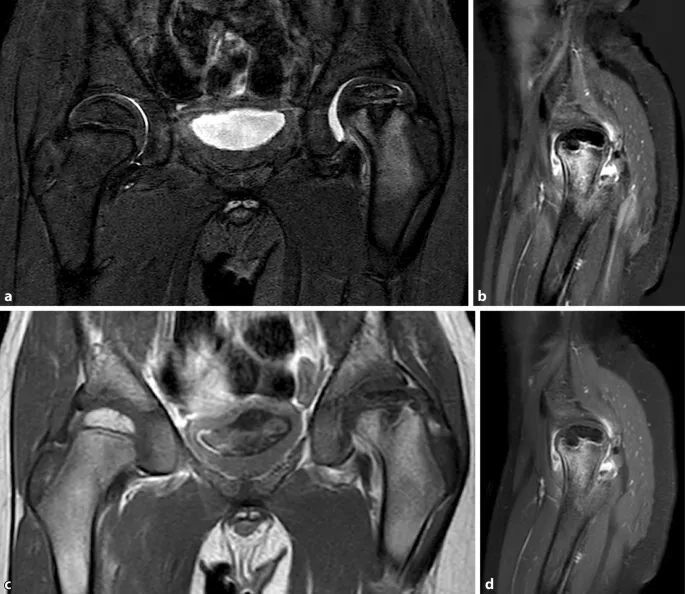 MRT Bild Morbus Perthes H&uuml;fte
