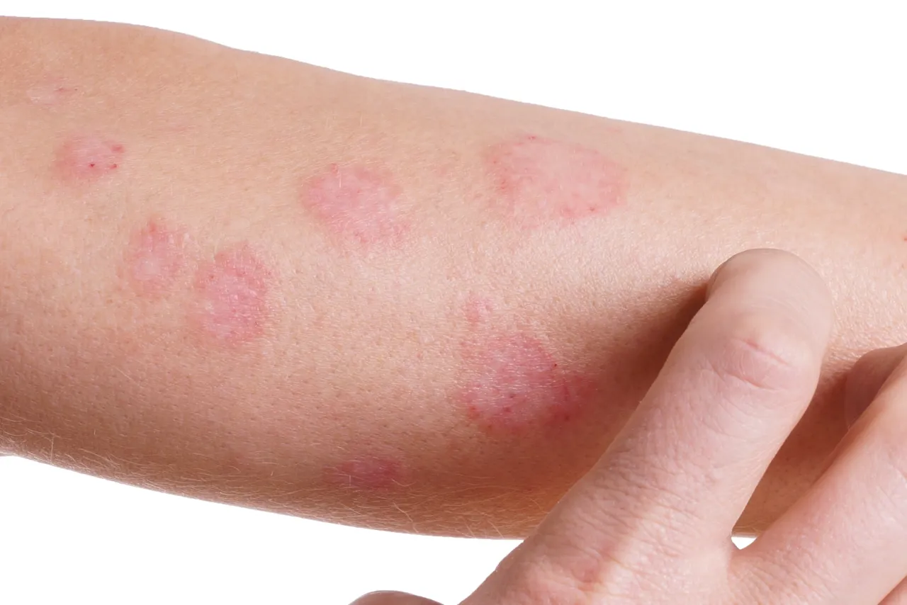 Objawy sk&oacute;rne nerwicy przykłady