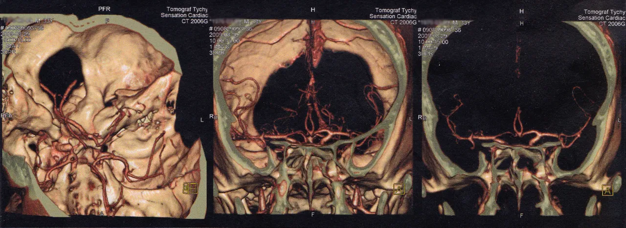 tomografia komputerowa z kontrastem obraz