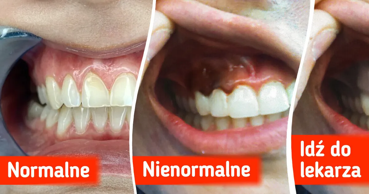 Objawy zapalenia dziąseł por&oacute;wnanie zdrowych i chorych dziąseł