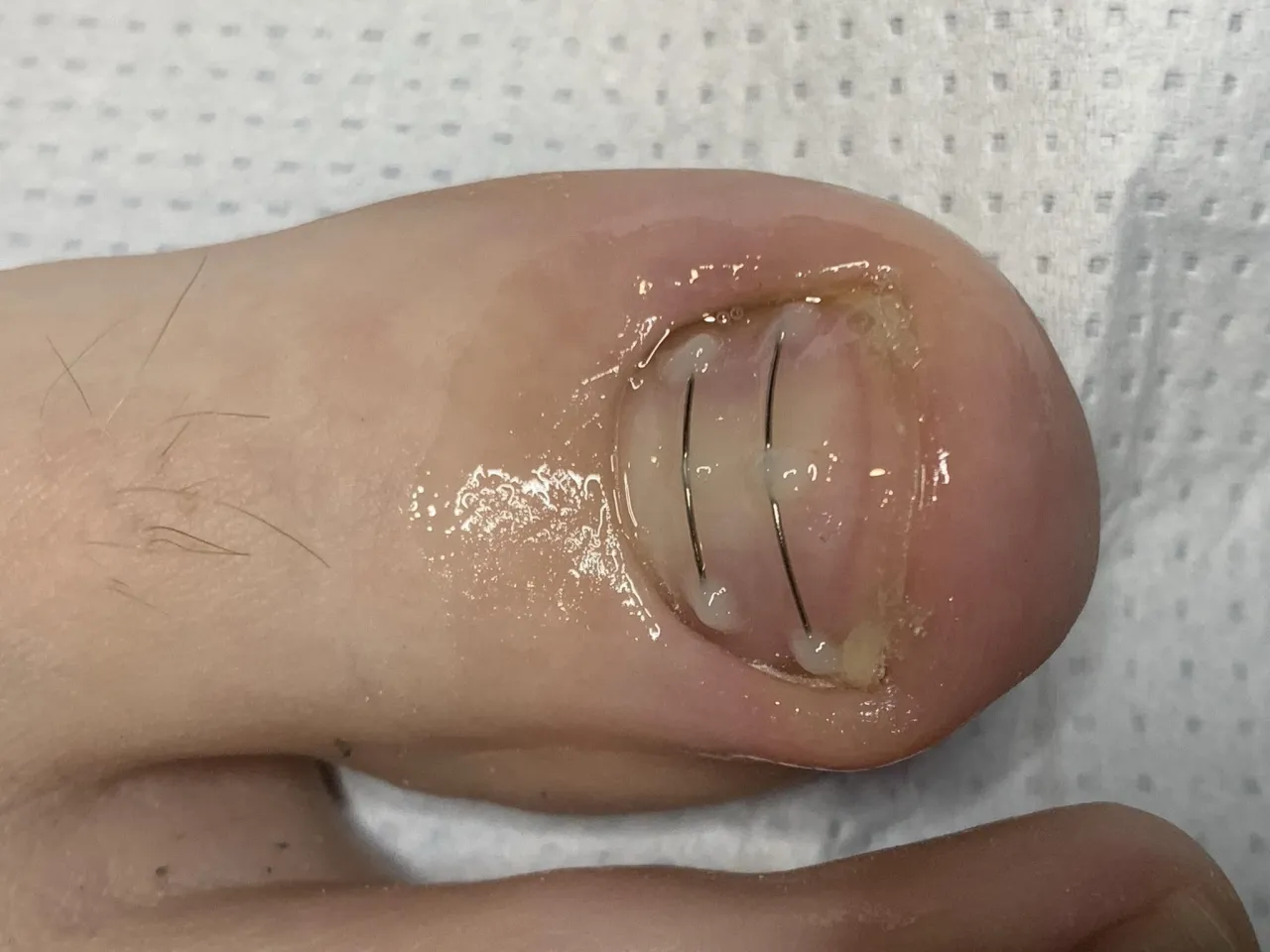 Klamry ortonyksyjne wrastający paznokieć