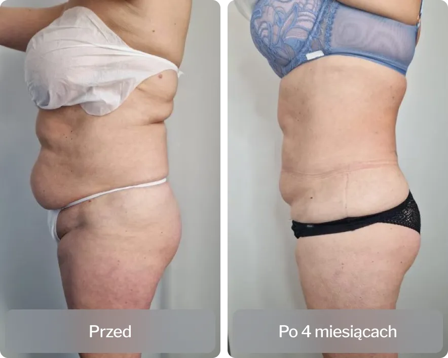 Liposukcja ultradźwiękowa schemat działania i harmonogram zabieg&oacute;w