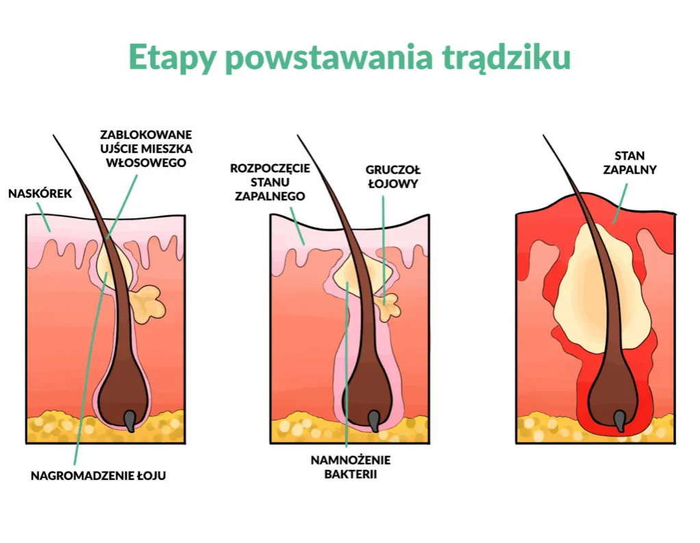 schemat powstawania trądziku, przyczyny trądziku