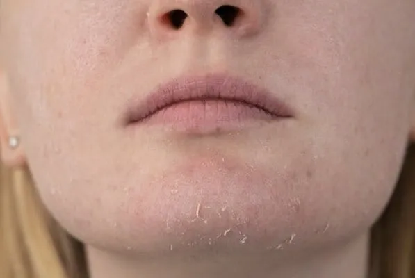 Zdjęcie Czy wyciskanie pryszczy jest dobre? Poznaj ryzyka i bezpieczne metody